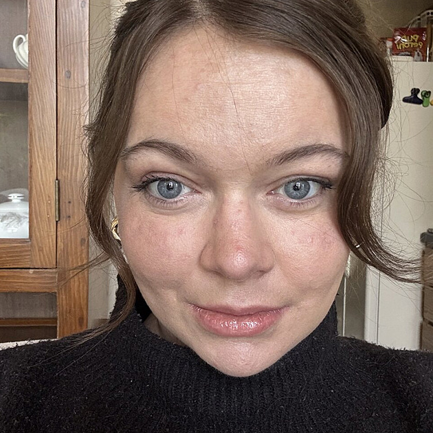 Žena trpí extrémní alergií na slunce. Ke spálení kůže jí stačí jen 30 sekund